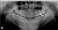 歯医者さんのレントゲン写真の見方｜パノラマレントゲン写真