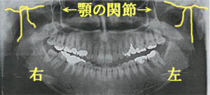 歯医者さんのレントゲン写真の見方｜顎関節