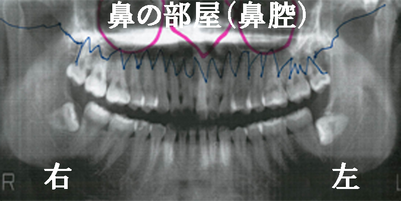 歯医者さんのレントゲン写真の見方｜上顎の見方