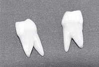 歯医者さんのレントゲン写真の見方｜奥歯の説明