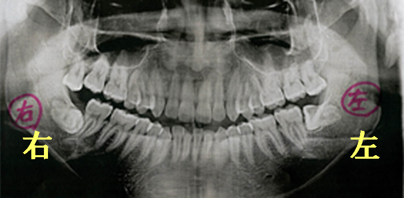 歯医者さんのレントゲン写真の見方｜香川県高松市の吉本歯科医院